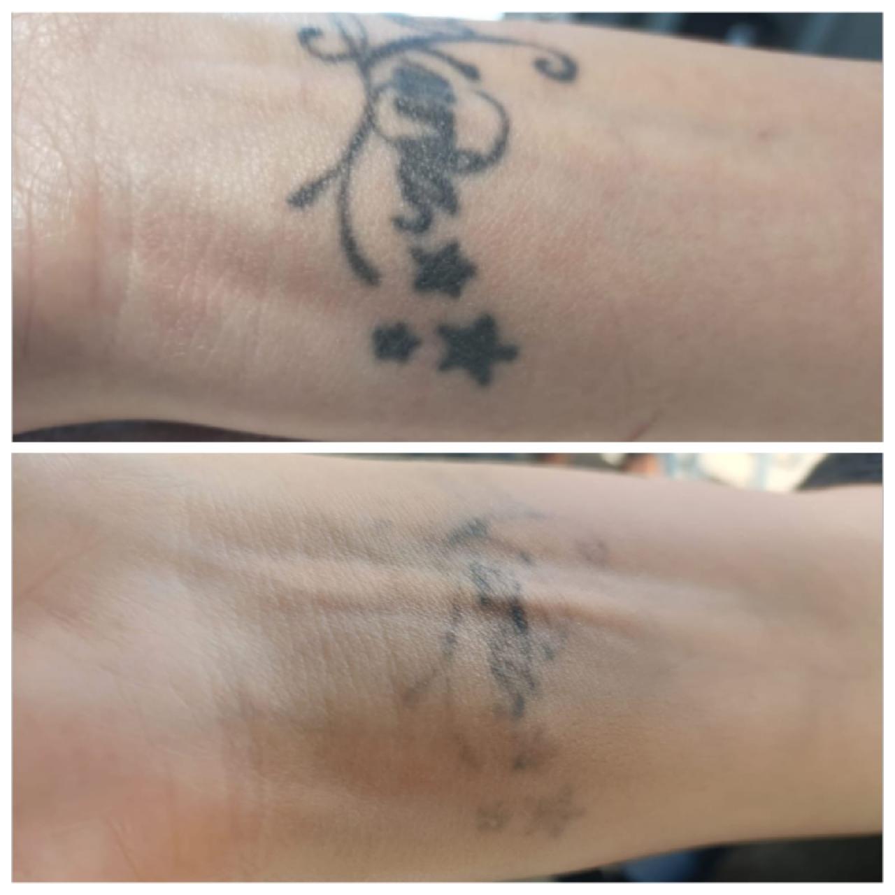Antes y después eliminación de tinta