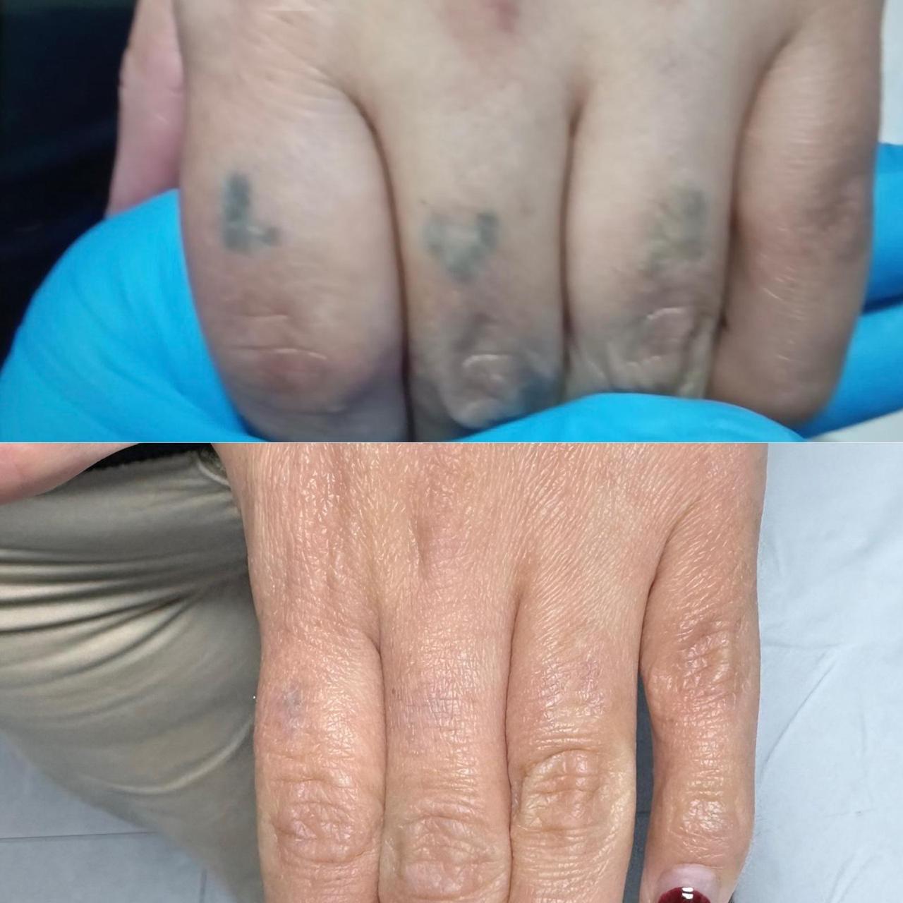 Evolución de borrado de tatuaje en InkOff