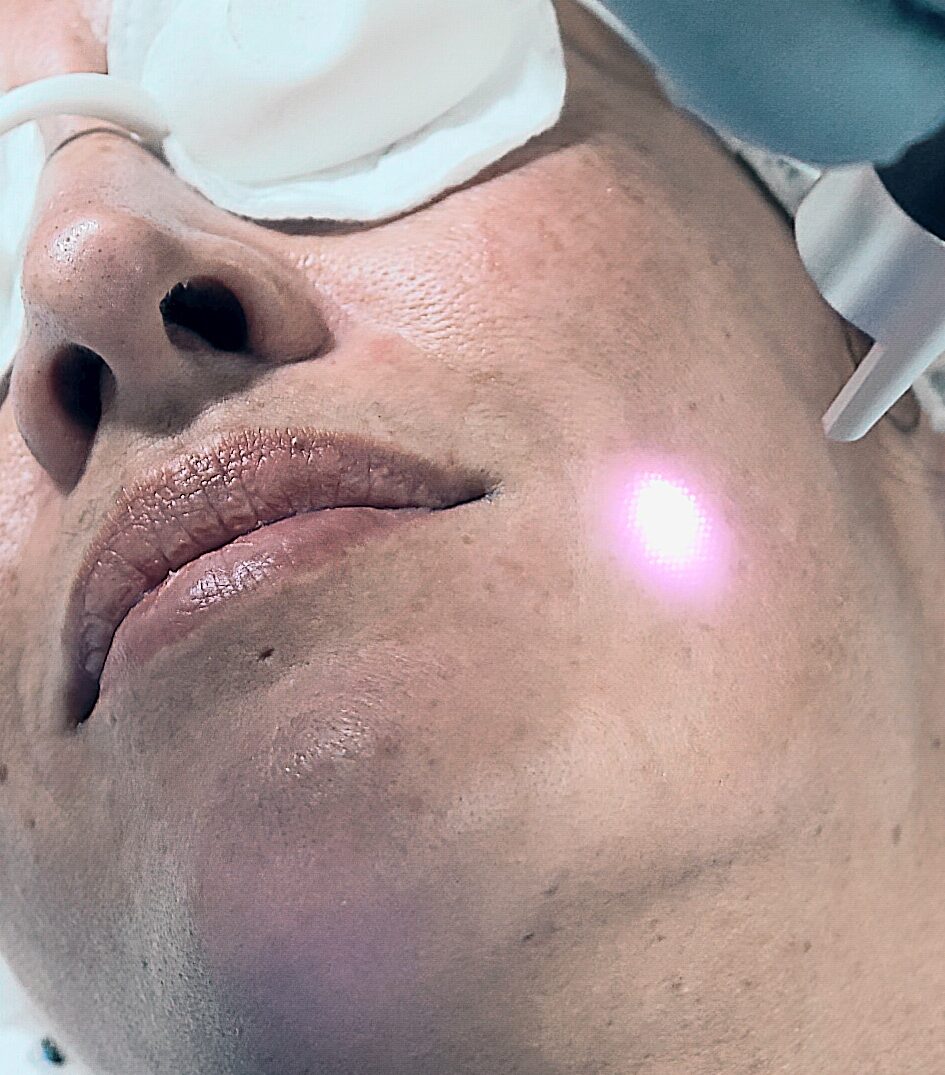 Rejuvenecimiento Facial Intradérmico Láser en InkOff