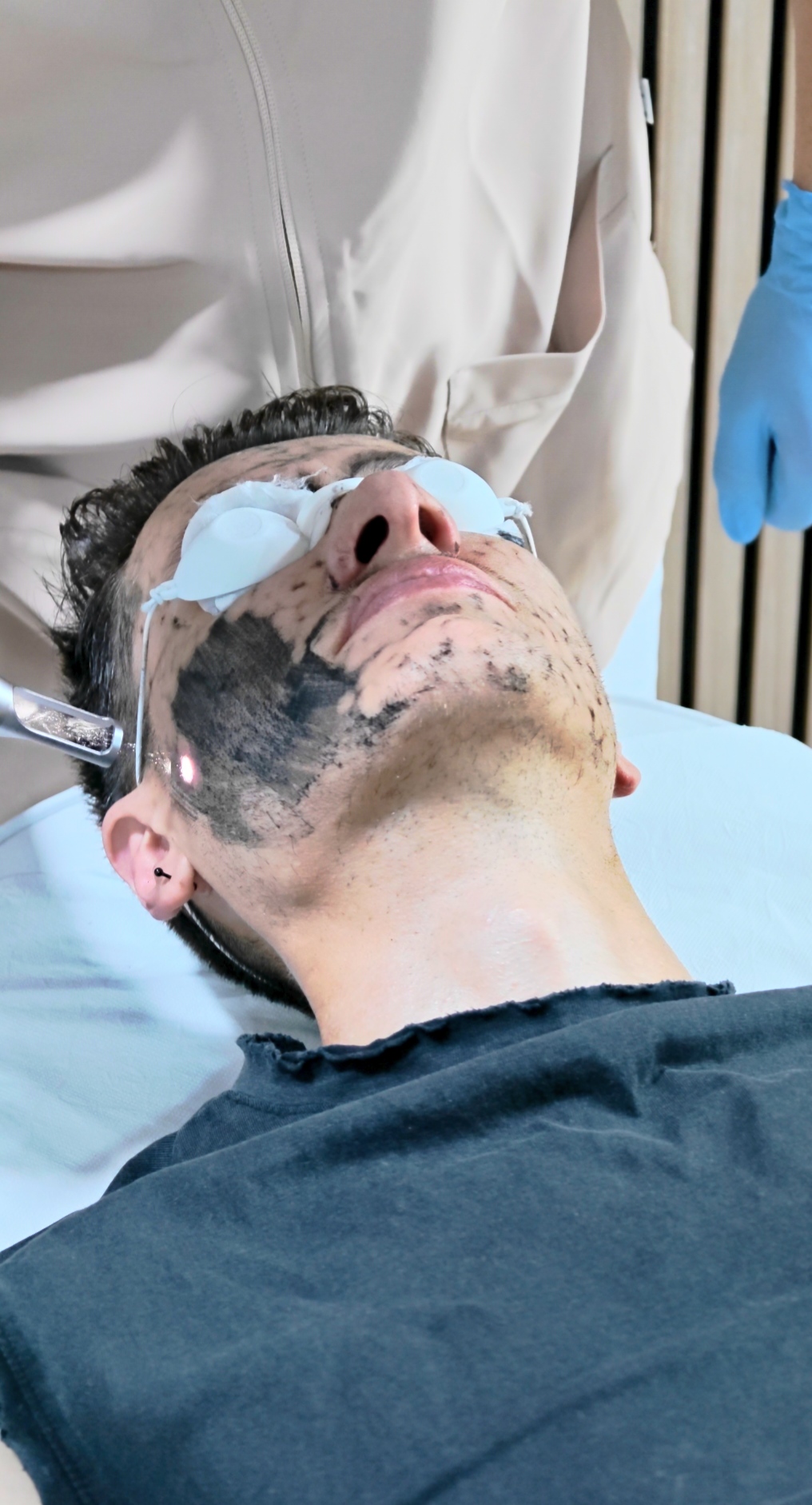 Tratamiento Hollywood Peel con Carbón Activo en InkOff